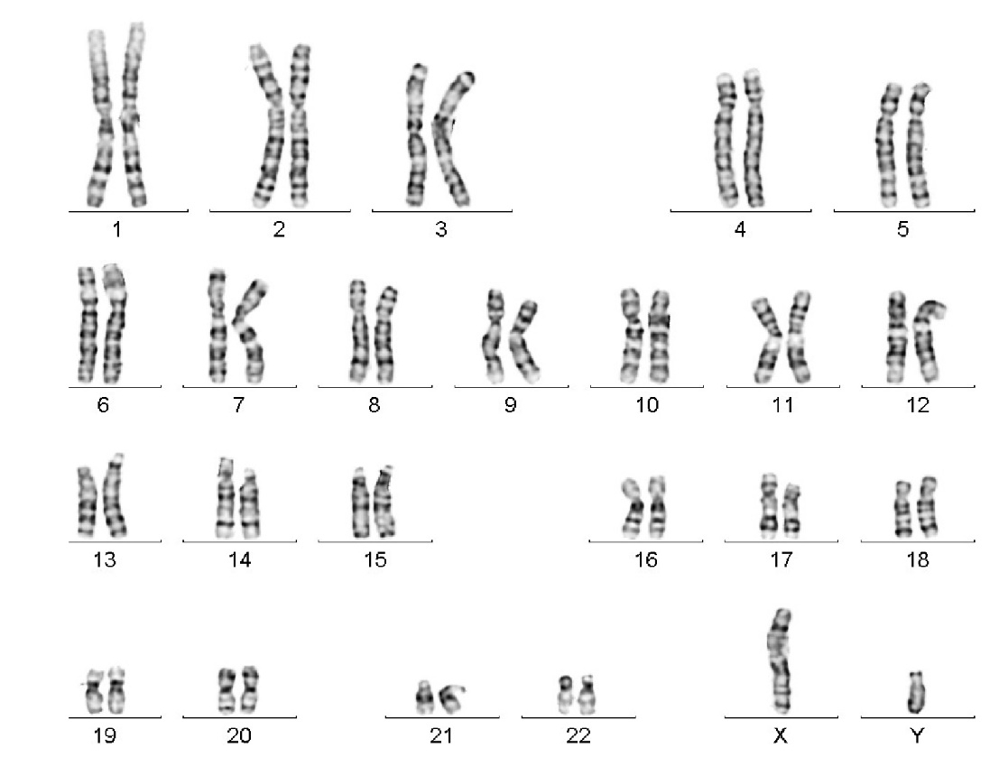 Sample karyotype analysis with numbered chromosomes